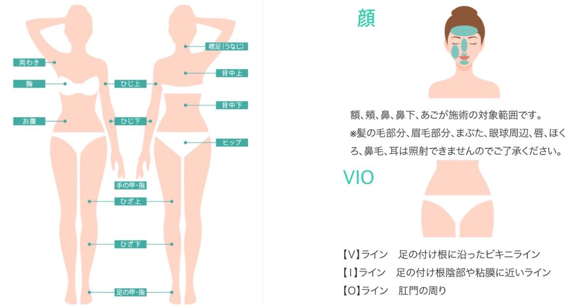 DMTC美容皮膚科の脱毛可能部位