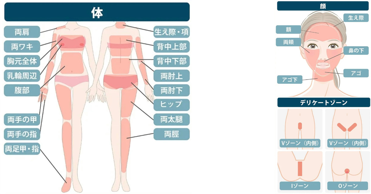 ジョウクリニックの脱毛可能部位